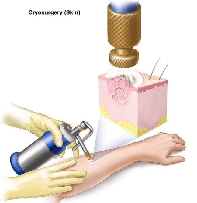 Skin cancer treatment options its Side effect & Prevention