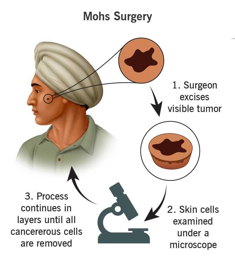 Skin cancer treatment options its Side effect & Prevention