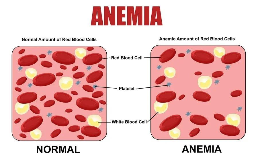 anemia 8 best treatment