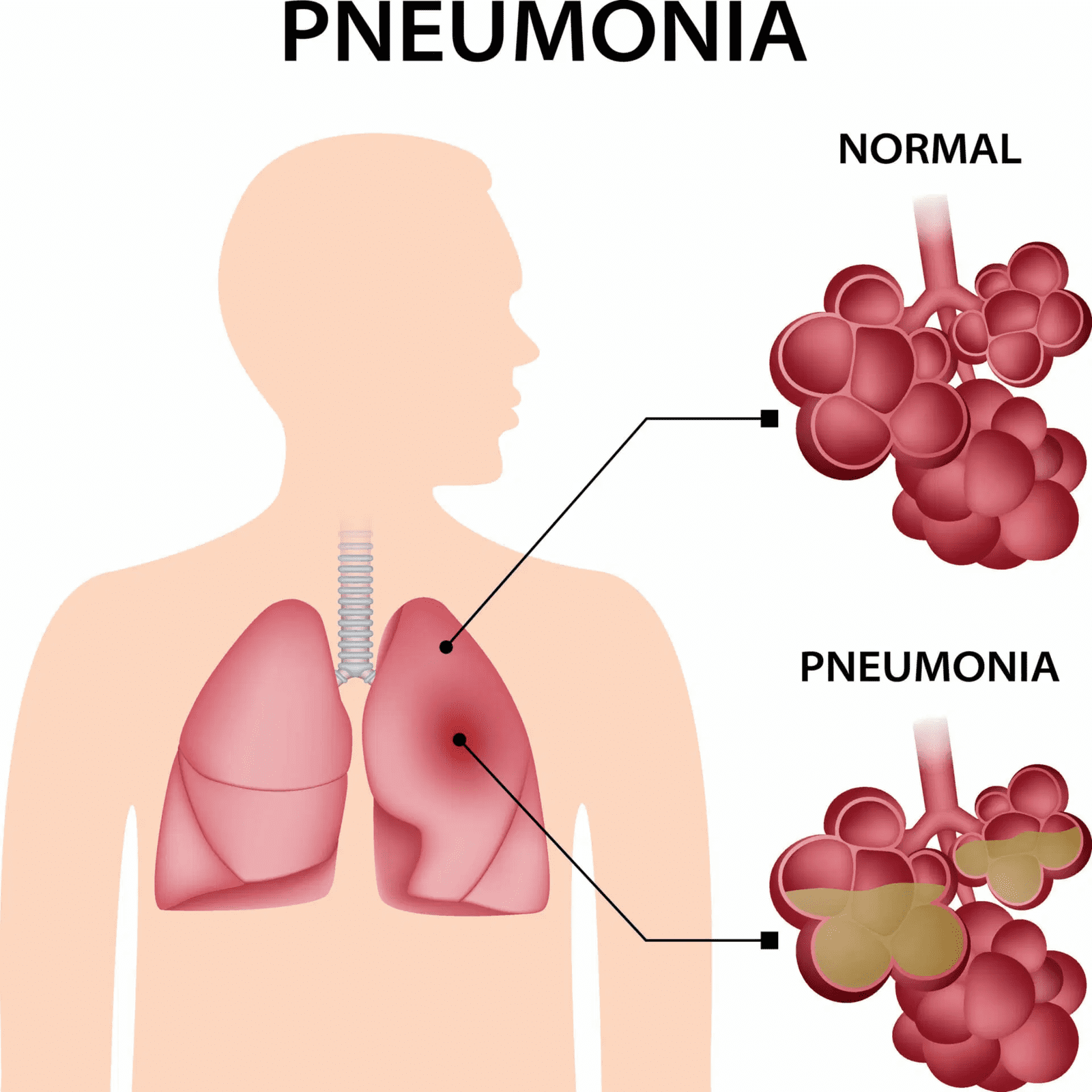 pneumonia symptoms basic 2024