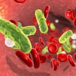 Sepsis basis symptoms, causes and 3 main stages